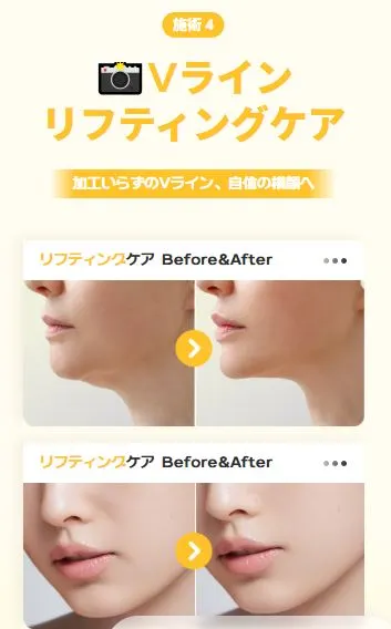 リフトアップ施術を比較