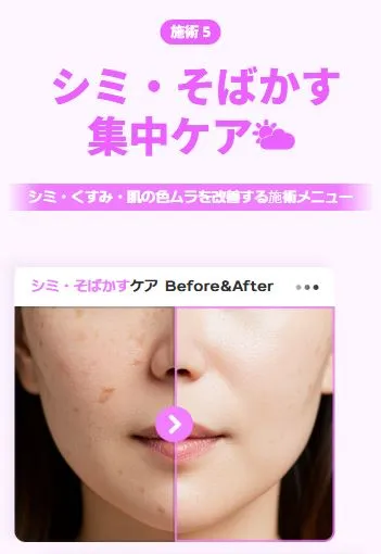 最新のシミ取りレーザー
